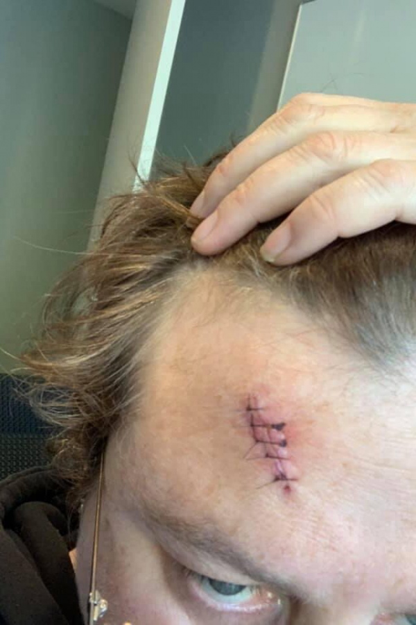 Chandra showing off five stitches in her forehead.